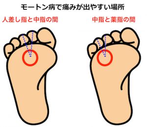 病 症状 モートン モートン病や浮指とは？足裏の激痛の原因や症状、肩こりを改善する6つの対処法